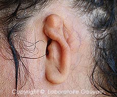 ablation de l'oreille