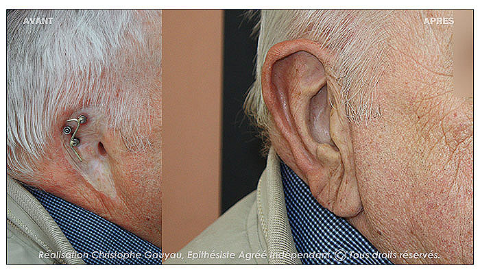 prothèse d'oreille sur implants